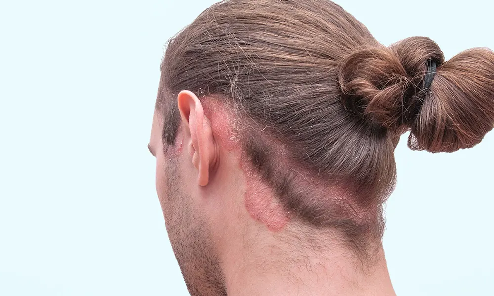 Sedef Hastalığı (Psoriazis)